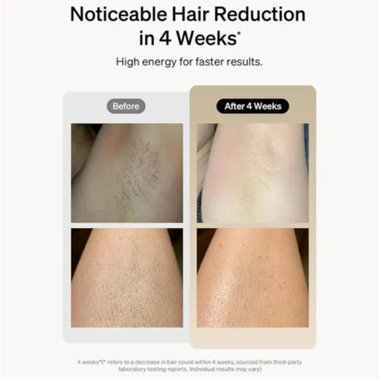 Professional Laser Epilator IPL Hair Removal Body Bikini Leg
